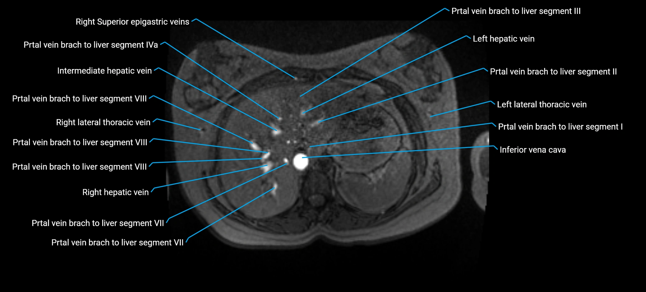 MRV abdomen pelvis & lower limb axial cross sectional anatomy labelled MRI image 32 (1).webp